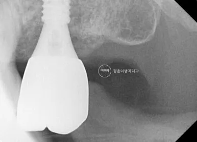 상악 구치부 임플란트에 최종 크라운을 장착한 뒤 적합 상태를 확인한 치근단 엑스레이