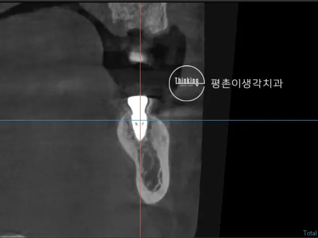 발치 예정 치아의 치근과 주위 치조골 상태를 세로로 잘라 확인한 임플란트 계획용 CT 단면