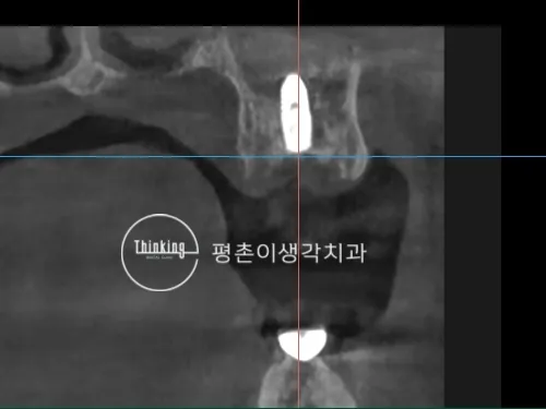 상악과 하악 같은 부위에 식립된 임플란트 픽스처의 위치와 주변 뼈를 확인한 CT 단면
