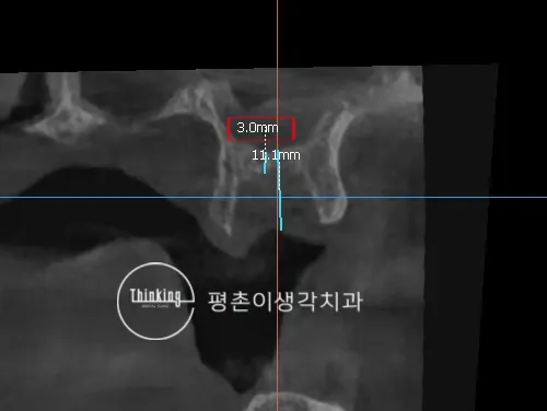 임플란트 식립 전 CT 단면에서 잔존 치조골의 폭 3.0mm와 높이 11.1mm를 계측한 영상