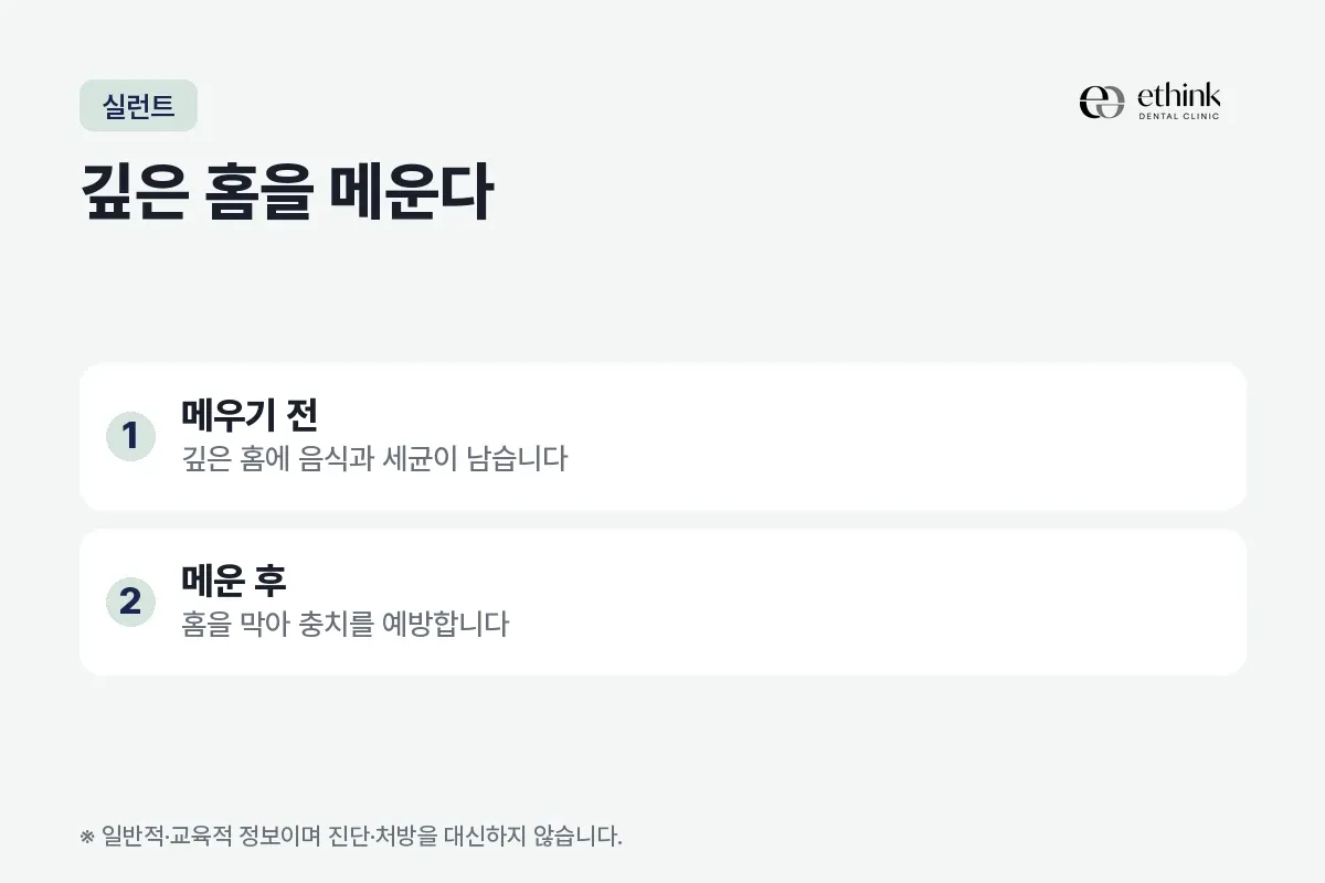 어금니 씹는 면의 깊은 홈을 메우기 전과 메운 뒤가 어떻게 다른지 정리한 카드