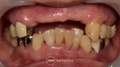 부분틀니를 뺀 치료 전 정면 구내 사진으로 상악 앞니 결손과 하악 앞니 마모가 보이는 상태