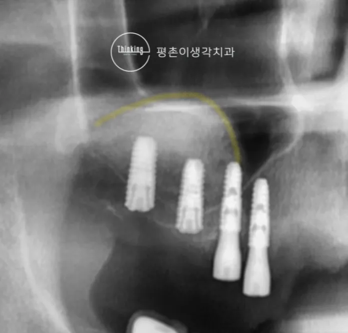 노란 선으로 표시한 거상된 상악동 바닥 아래에 임플란트 네 개가 식립된 상태의 엑스레이