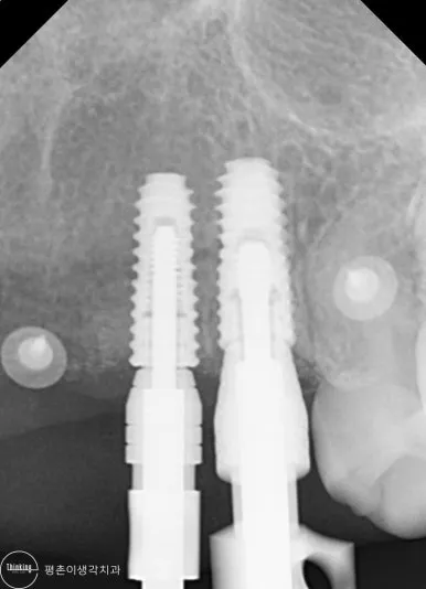 임플란트 두 개에 맞춤 지대주를 연결한 상태와 주변 치조골을 확인한 근접 치근단 엑스레이