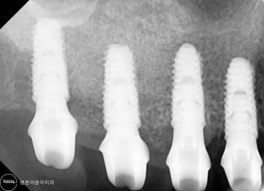 맞춤 지대주를 체결한 상악 임플란트 네 개와 주변 치조골 높이를 확인한 치근단 엑스레이