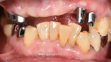 상악 임플란트에 금속 맞춤 지대주를 체결한 상태를 정면에서 촬영한 구내 사진