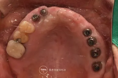 상악 교합면 구내 사진으로 체결된 맞춤 지대주 여섯 개와 남아 있는 자연치가 보이는 상태