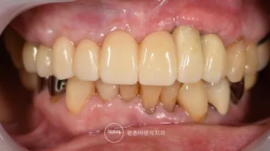 최종 보철물을 장착한 뒤 측방에서 촬영한 구내 사진으로 상하악 치아가 맞물린 상태