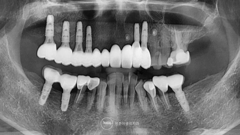 상악 임플란트 여섯 개 위에 최종 보철물을 장착해 교합을 완성한 치료 후 파노라마 엑스레이
