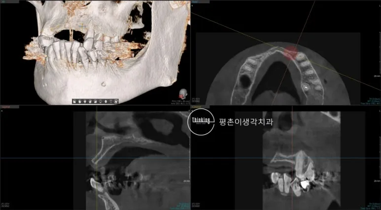 임플란트 식립 계획을 위해 상악의 3차원 영상과 축면, 시상면 단면을 함께 확인한 치료 전 CT 화면