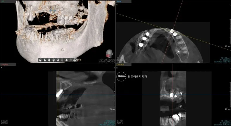 상악동 거상술과 뼈이식 부위의 회복 상태를 3차원 영상과 여러 단면으로 확인한 식립 후 CT 화면