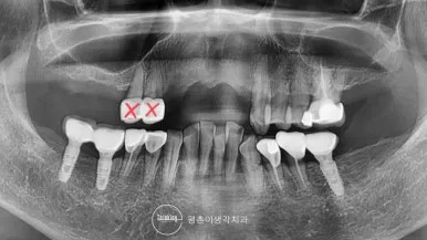 상악 잔존 치근과 발치가 필요한 치아를 붉은 X 표시로 나타낸 치료 전 파노라마 엑스레이