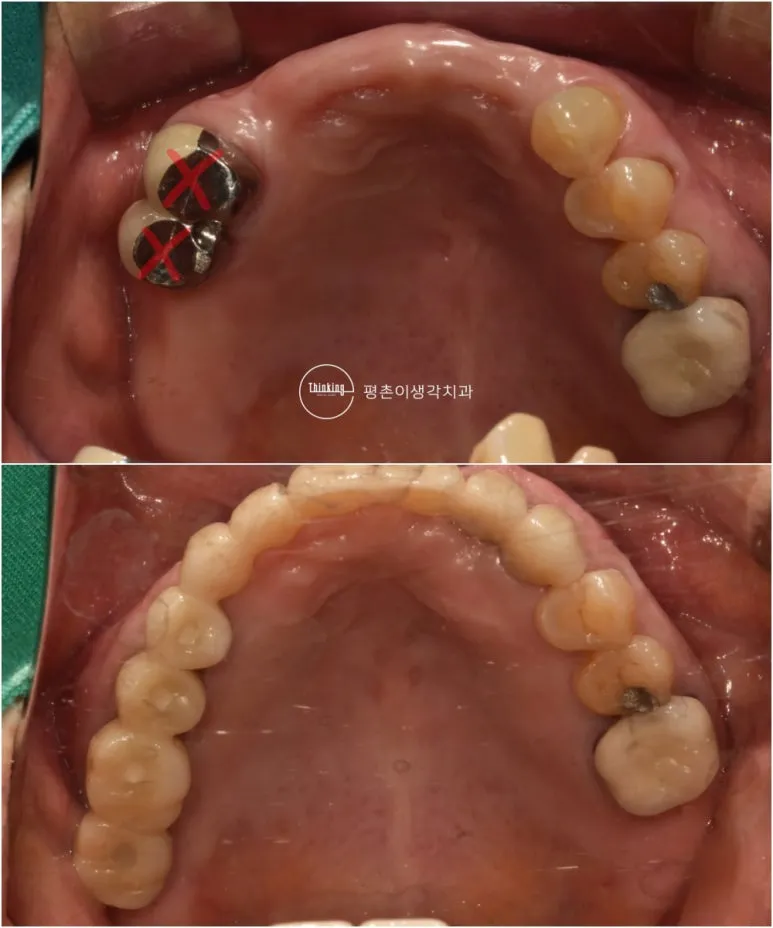 상악 교합면을 치료 전후로 비교한 사진, 발치 대상 치아를 X로 표시한 전과 보철을 완성한 후