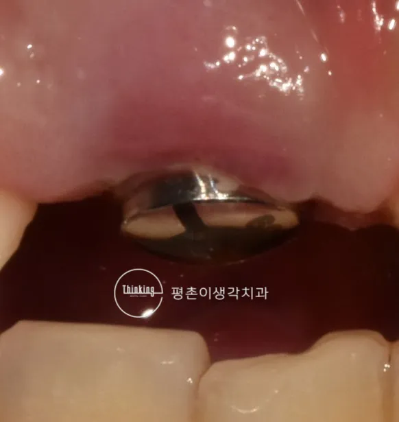 발치한 앞니 자리에 식립한 임플란트에 치유 지대주를 연결하고 잇몸이 아문 상태의 근접 구내 사진
