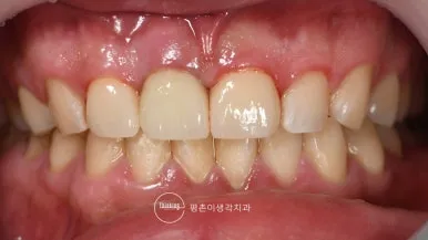임플란트와 크라운 수복을 마친 상악 앞니를 위아래 치아가 맞물린 상태로 촬영한 치료 후 정면 구내 사진