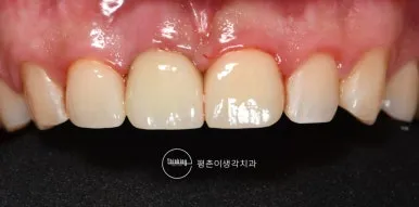 치료를 마친 상악 앞니 보철물의 형태와 잇몸 라인을 가까이에서 확인한 치료 후 근접 구내 사진