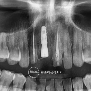 상악 앞니에 식립한 임플란트와 주변 뼈 상태를 확인하려고 촬영한 치료 후 경과 파노라마 방사선 사진