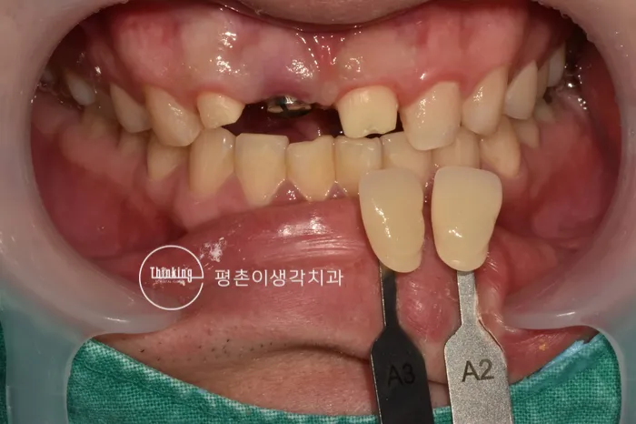 앞니 보철물 색을 정하려고 A2와 A3 셰이드 가이드를 입가에 대고 비교하는 정면 구내 사진