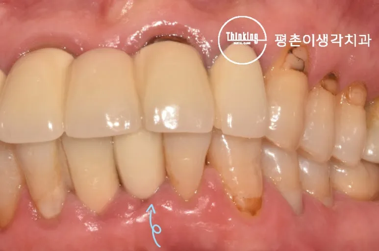 치료 전 아래 앞니에 씌워진 기존 보철물과 잇몸 퇴축, 착색 부위를 화살표로 표시한 구내 사진