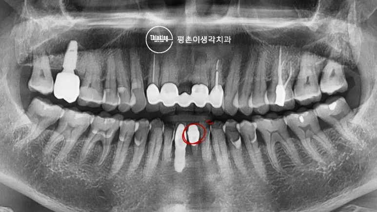 아래 앞니 문제 부위를 붉은 원으로 표시한 치료 전 전악 파노라마 방사선 사진