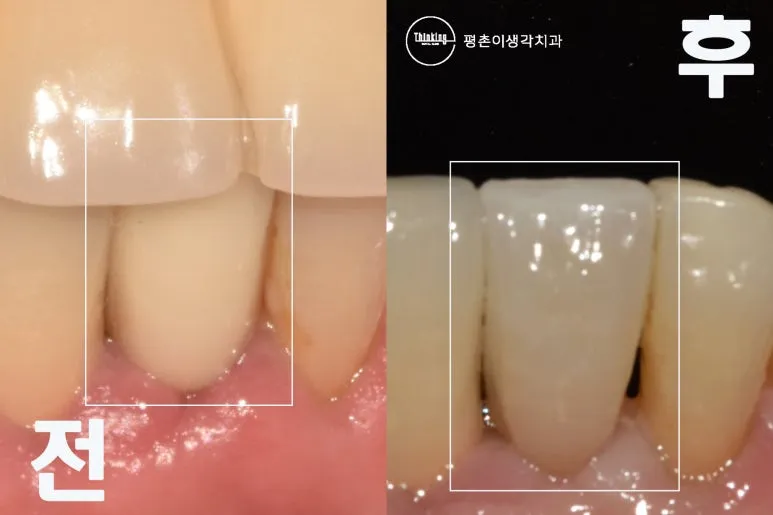 아래 앞니 임플란트 치료 전과 치료 후 같은 부위를 흰 사각형으로 표시해 나란히 붙인 비교 사진