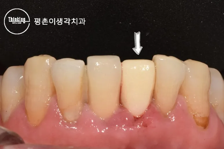 아래 앞니 31번 임플란트 자리에 임시치아를 끼워 옆 치아와 어울리는지 확인한 정면 구내 사진