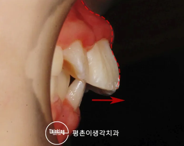 치료 전 구강 내 측면 사진, 위 앞니가 앞으로 나와 수평피개가 큰 상태를 붉은 점선과 화살표로 표시