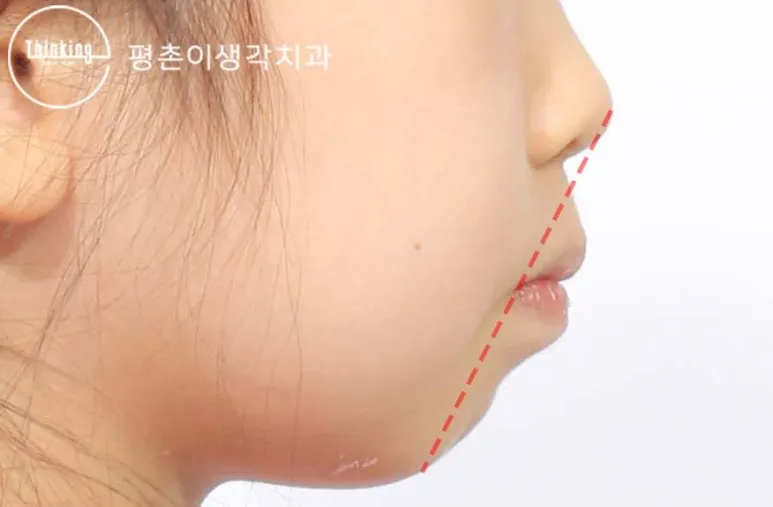 치료 전 옆모습, 코와 턱끝을 이은 붉은 점선보다 입술이 앞으로 나와 있는 상태