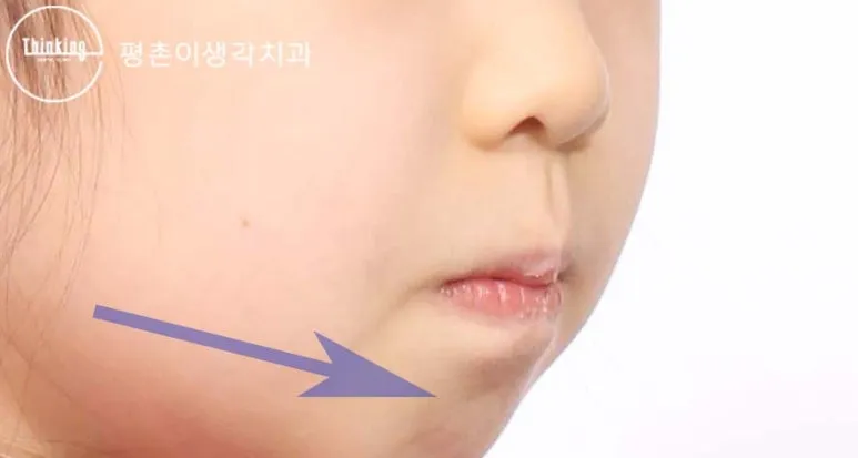 입술을 다물 때 턱끝에 힘이 들어가는 부위를 화살표로 표시한 치료 전 옆모습