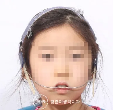 상방견인 헤드기어를 착용한 정면 모습