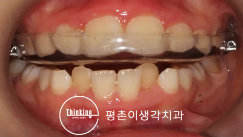 치료에 함께 사용한 구강 내 투명 장치