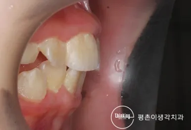 치료 후 구강 내 측면 사진, 위아래 앞니의 앞뒤 간격이 줄어든 모습