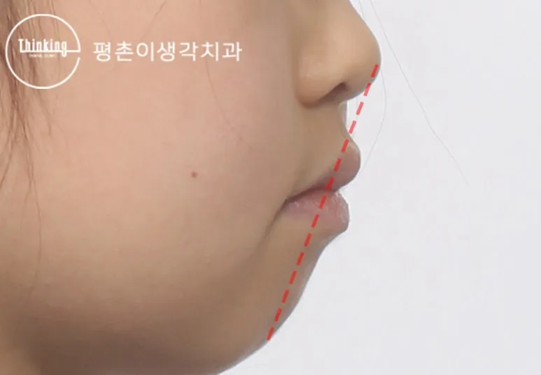 치료 후 옆모습, 앞니와 입술의 돌출감이 완화된 상태