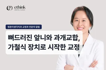 뻐드러진 앞니와 과개교합, 가철식 장치로 시작한 교정
