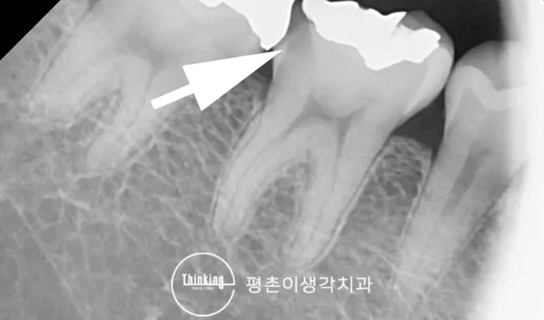 금 인레이 아래 이차충치가 의심되는 부위를 흰 화살표로 표시한 치근단 방사선 사진