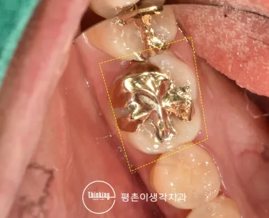 금 인레이가 있는 어금니를 주황 사각형으로 표시한 아래턱 교합면 구강 사진