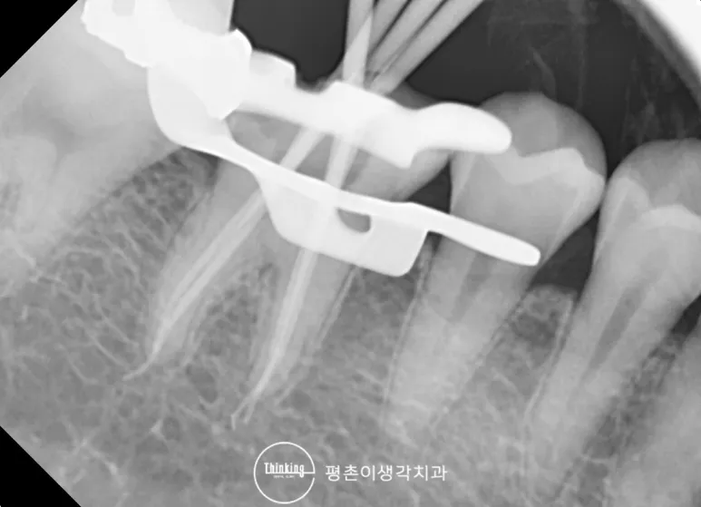 신경치료를 진행하며 근관 길이를 확인한 치근단 방사선 사진