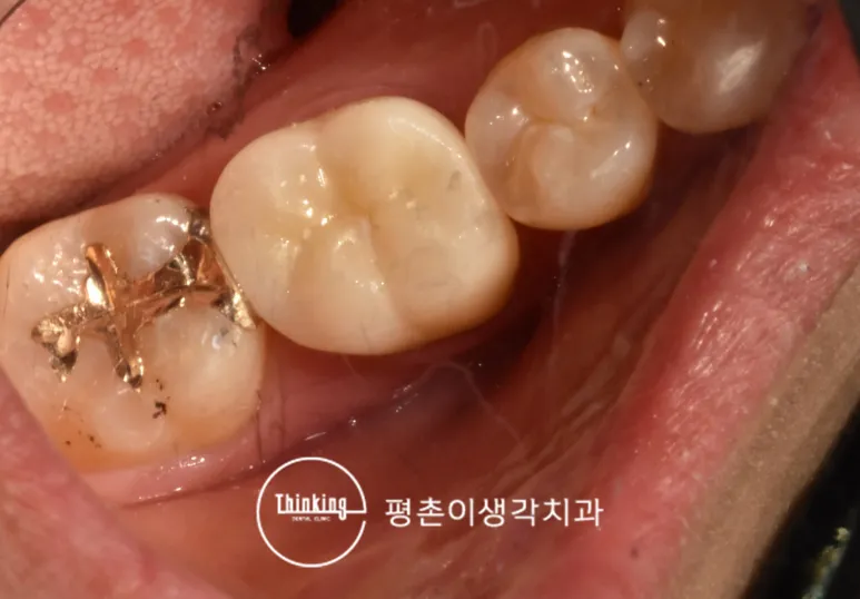 신경치료 후 크라운으로 수복을 마친 어금니 부위 구강 사진