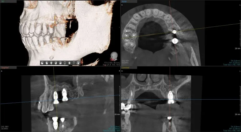뼈이식과 함께 임플란트 고정체를 식립한 뒤 확인한 3차원 CT 영상