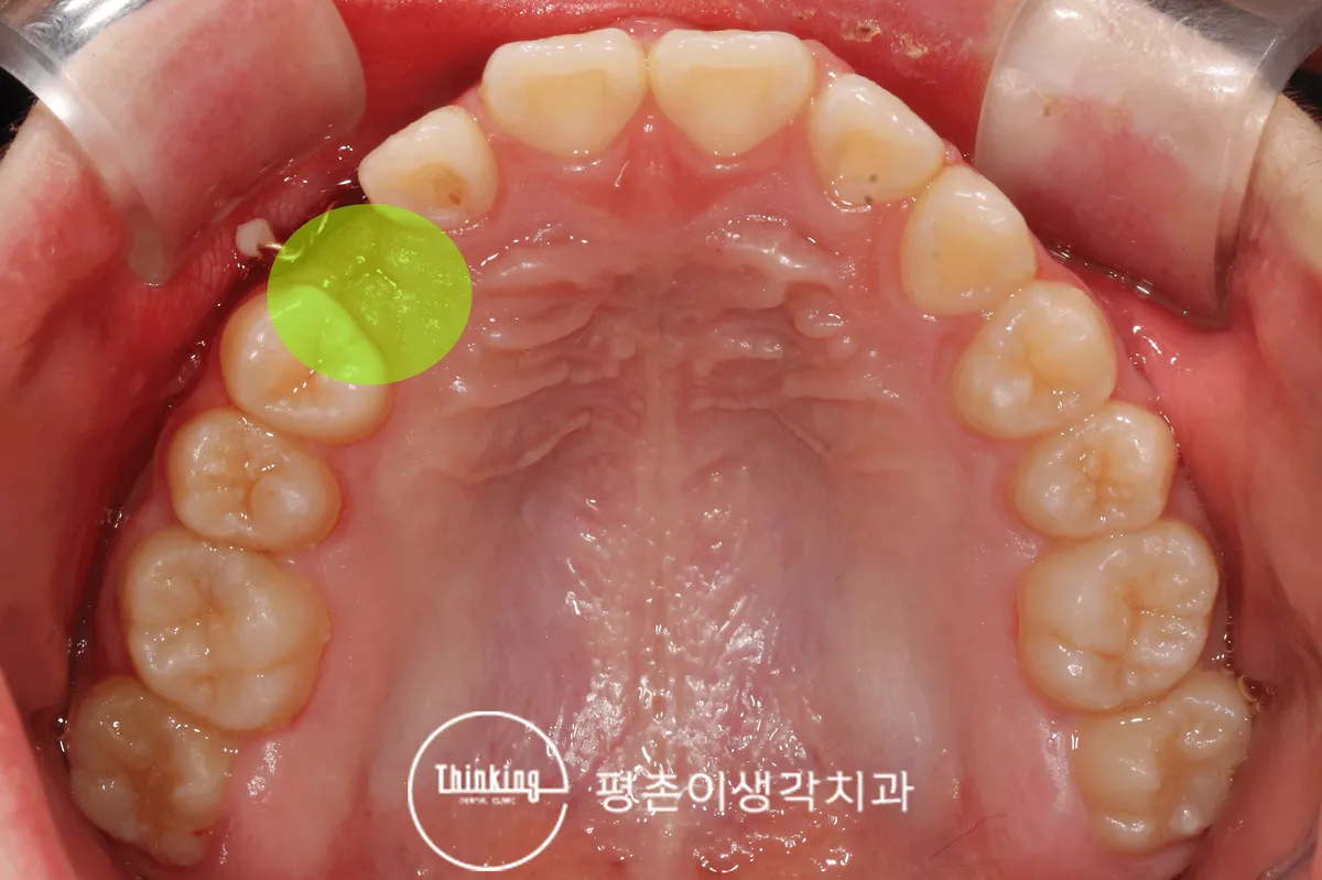 매복치 견인 전 위턱 교합면 구강사진, 정상 맹출 경로를 벗어난 치아