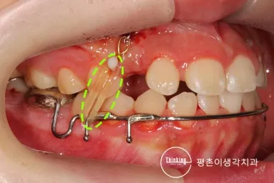 매복치 개창술 후 버튼과 고무줄을 연결한 교정적 견인 장치