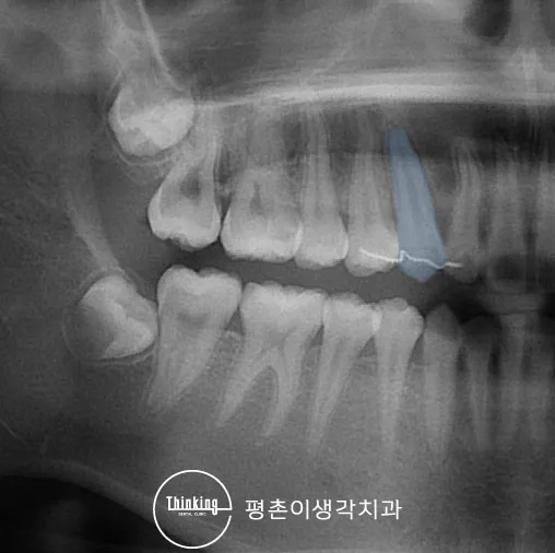 매복치 견인 후 치아가 치열 안으로 이동한 파노라마 엑스레이