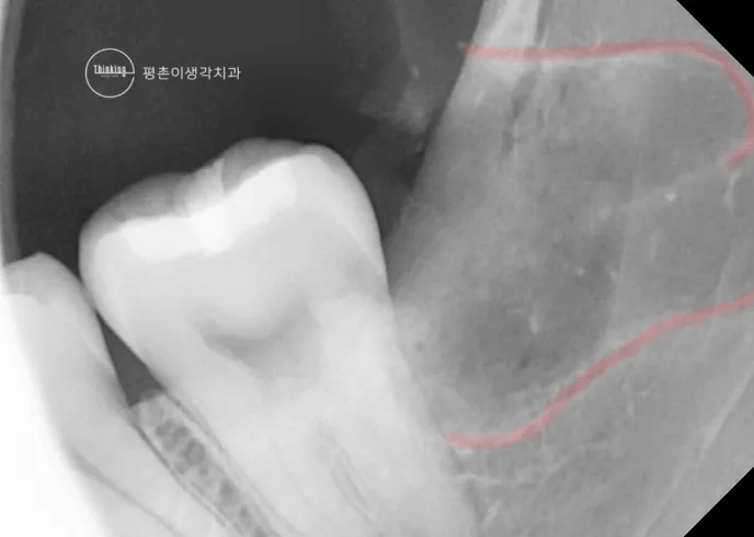 아래턱 맨 안쪽 어금니 부위를 확대한 치근단 방사선 사진으로 하치조신경관이 지나는 길을 빨간 선으로 표시