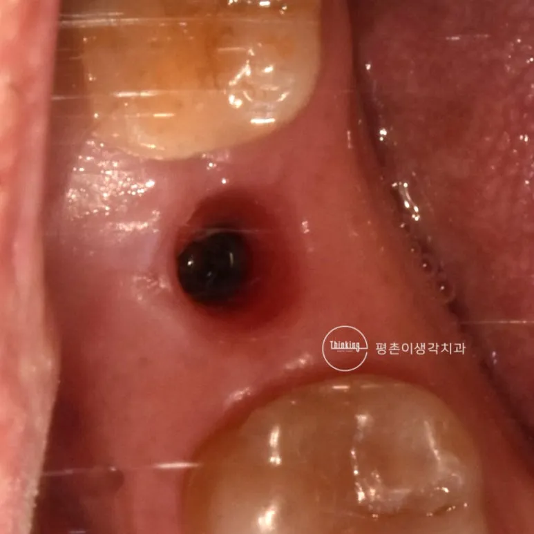 2차 수술로 잇몸을 열어 임플란트 고정체 상부가 드러난 구강 사진