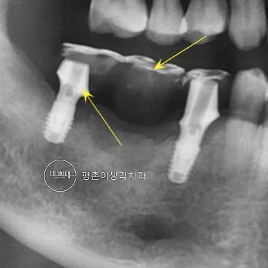 맞춤 지대주 부위를 노란 화살표로 표시한 어금니 부위 방사선 사진