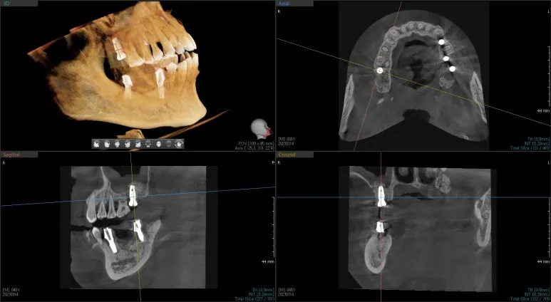 임플란트 식립 상태를 확인한 3차원 CT 영상