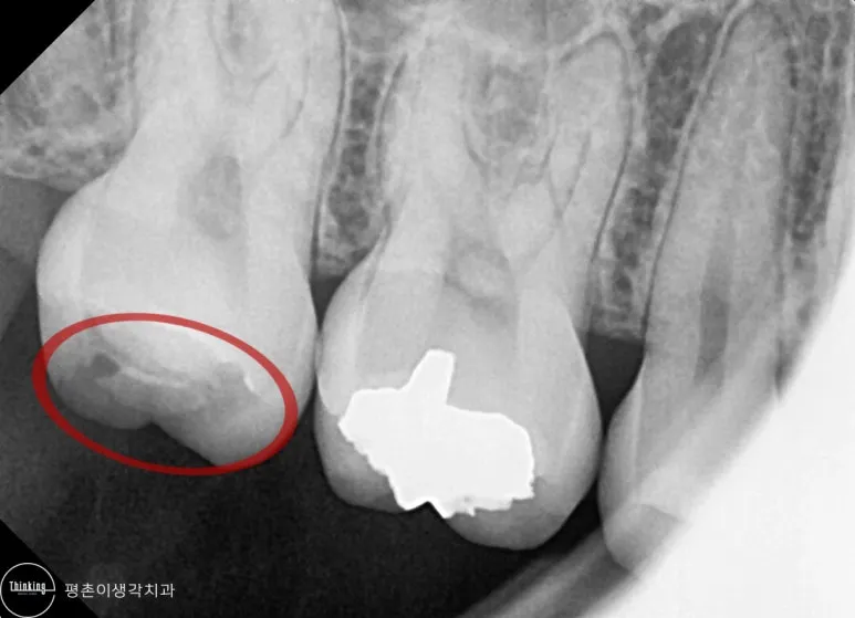 인레이가 빠진 어금니 부위를 붉은 타원으로 표시한 치근단 방사선 사진
