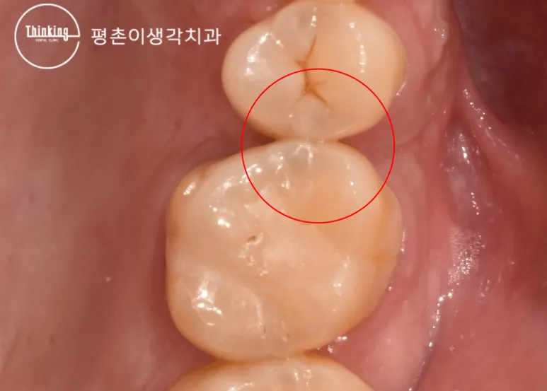 큰어금니와 작은어금니가 맞닿는 인접면의 거뭇한 부위를 붉은 원으로 표시한 구강 사진