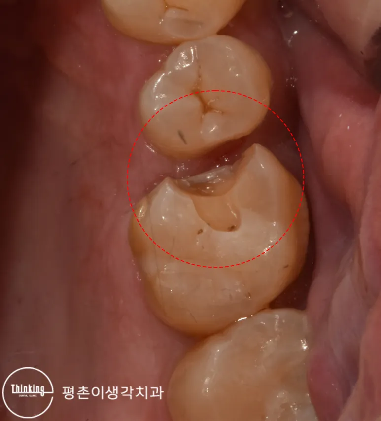 우식을 제거해 큰어금니 인접면이 넓게 파인 와동, 붉은 점선으로 범위를 표시한 사진