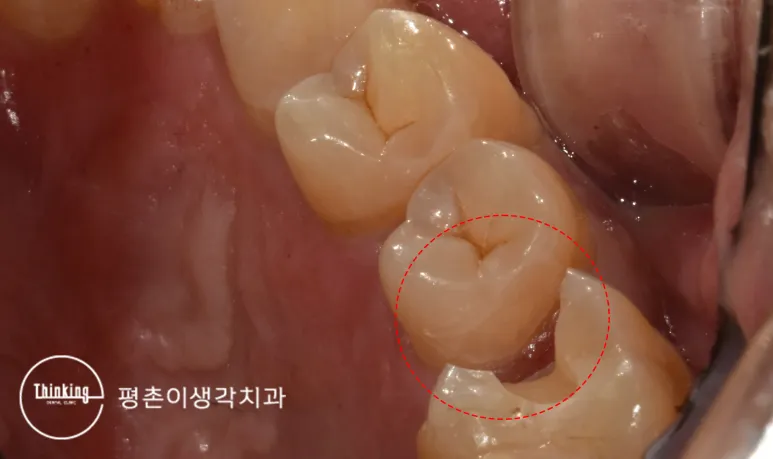 인접한 큰어금니와 작은어금니 두 곳을 모두 삭제한 뒤의 와동을 붉은 점선으로 표시한 사진
